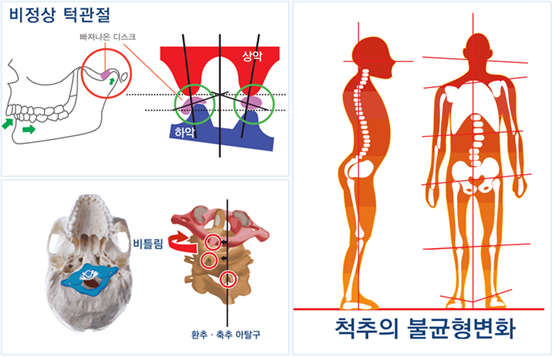 턱관절치료원리